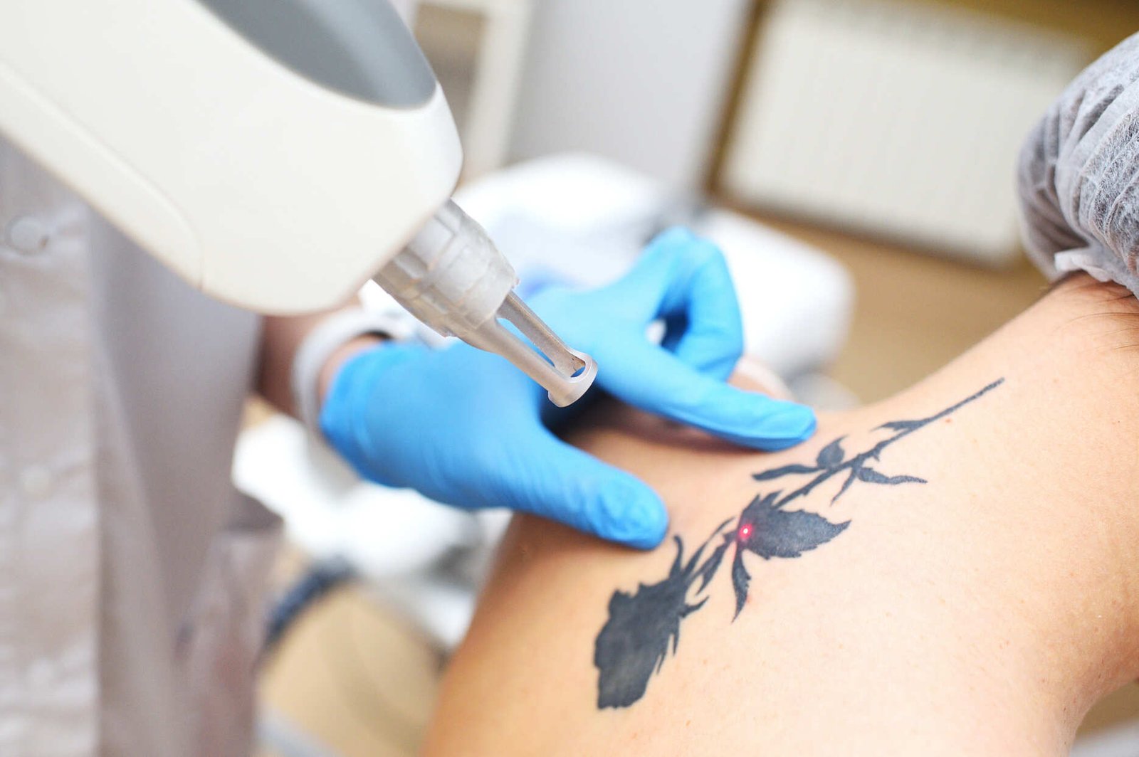 eliminación-de-tatuajes