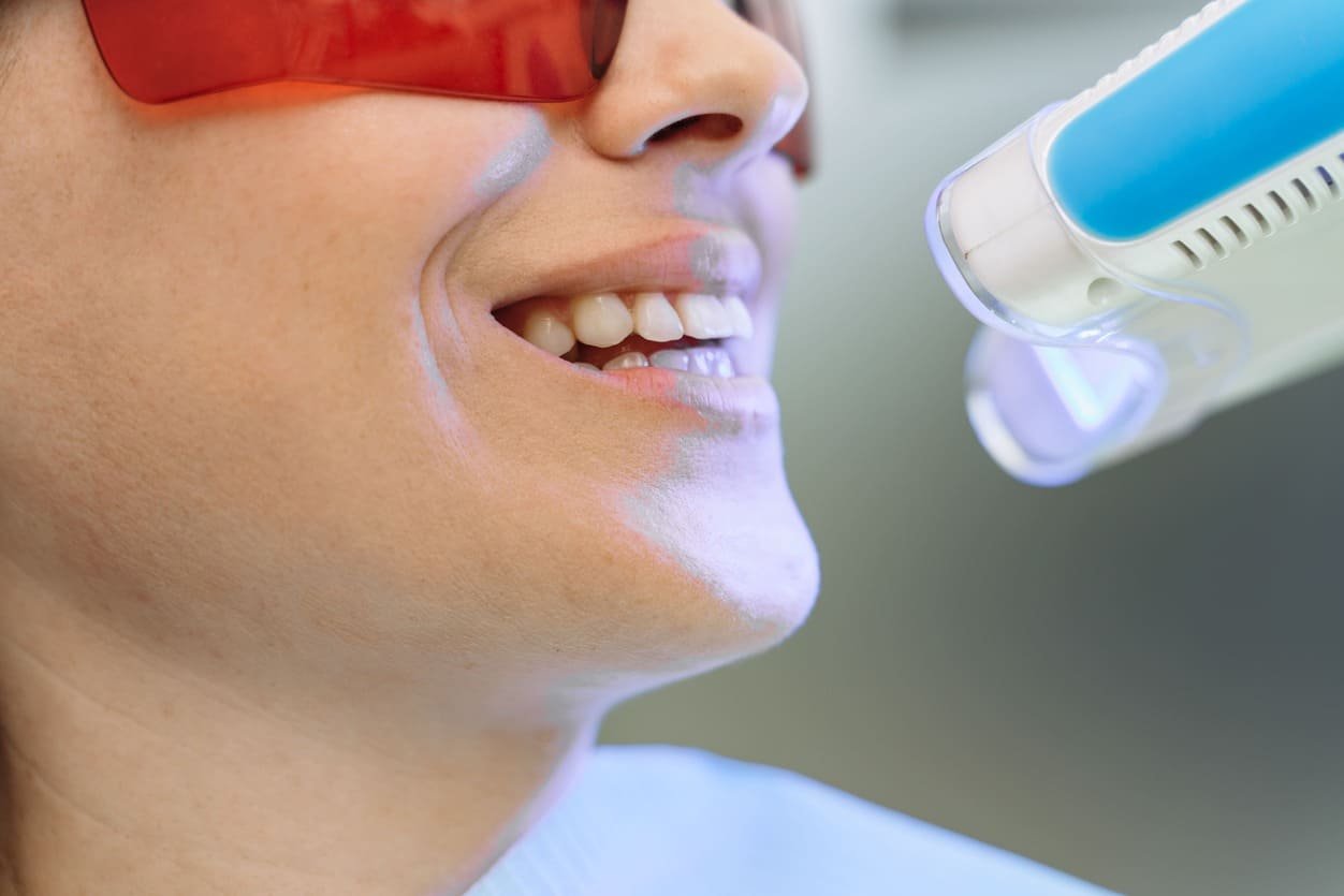 blanqueamiento-dental